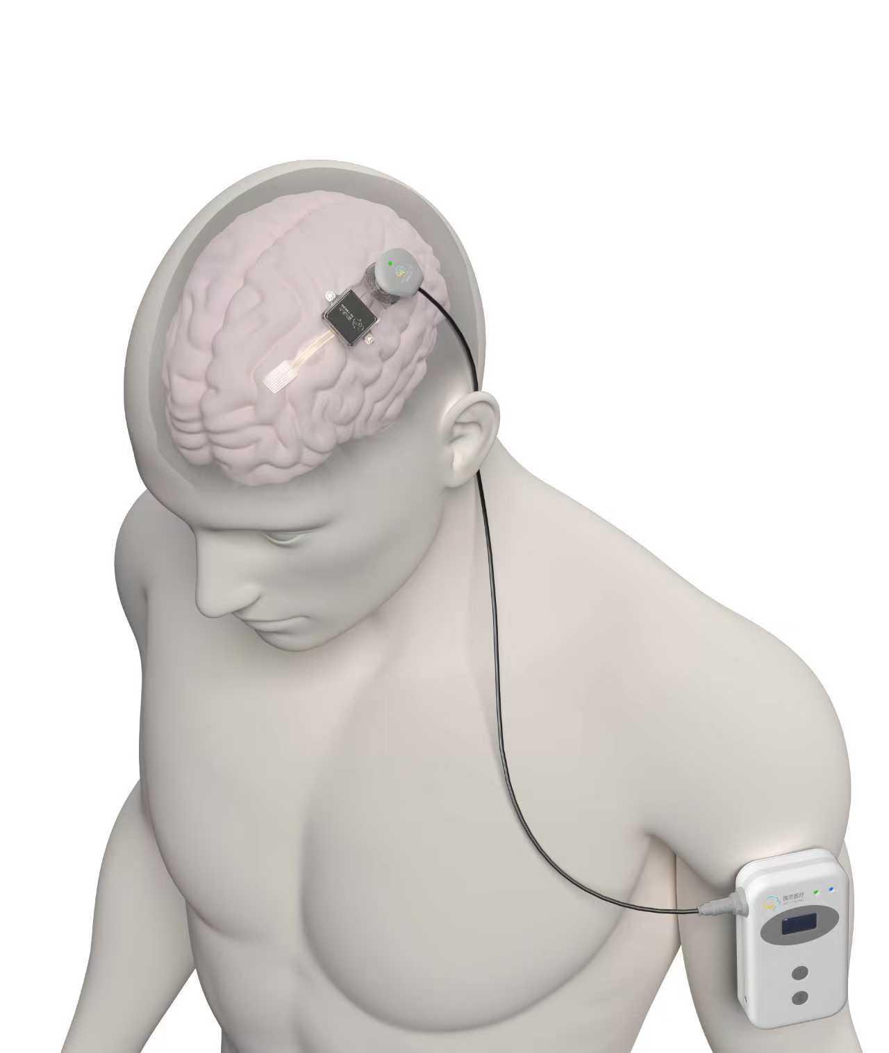 星空智能科技：锚定生命健康战略需求：南方医科大学打造医工融合成果转化新引擎｜智汇湾区科创无限(图4)