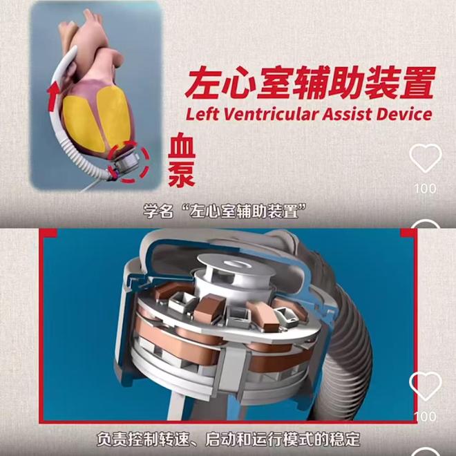 「深度」国产人工心的商业暗战